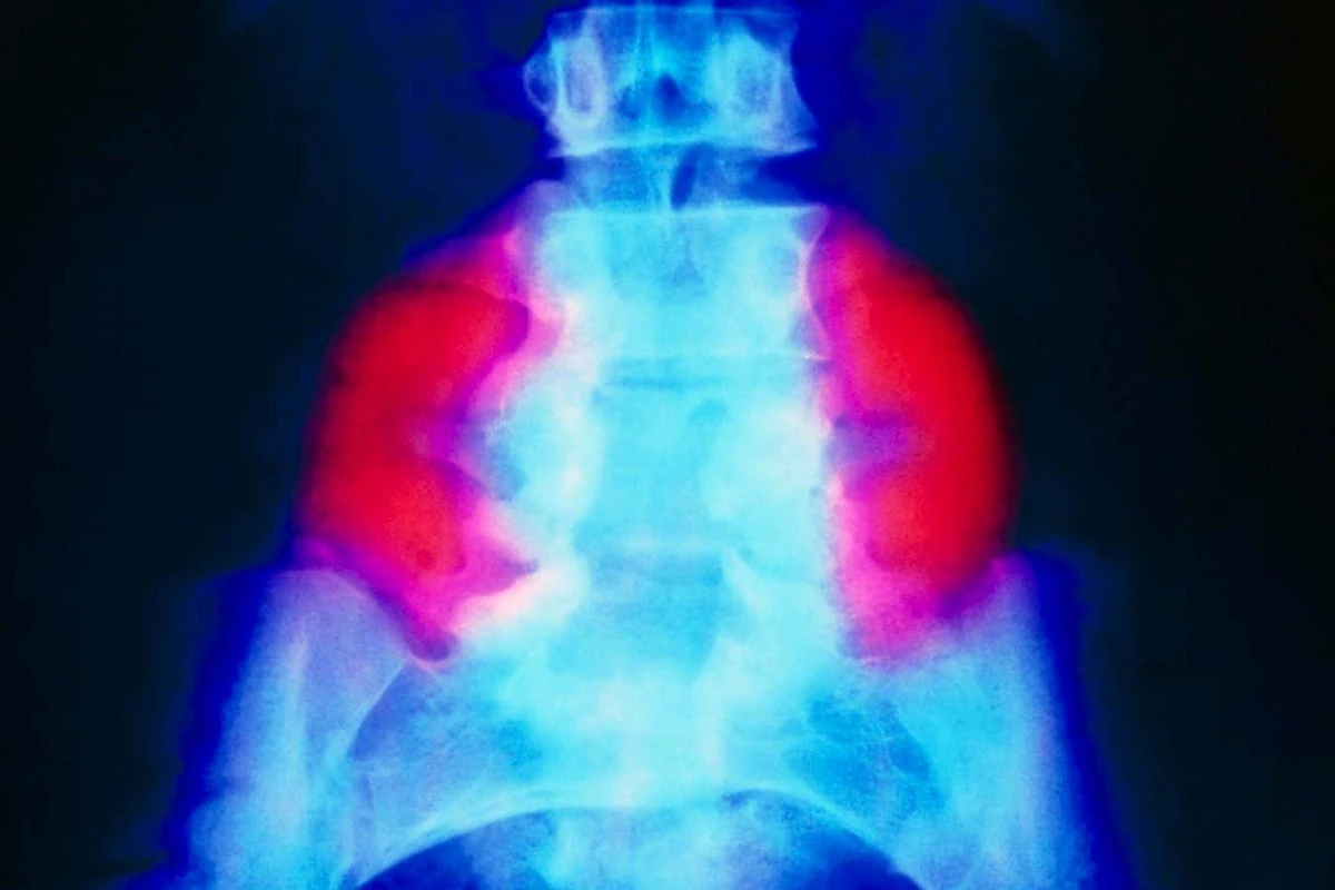 Waarom chirurgen nu een stamcelpleister gebruiken bij baby's in de baarmoeder