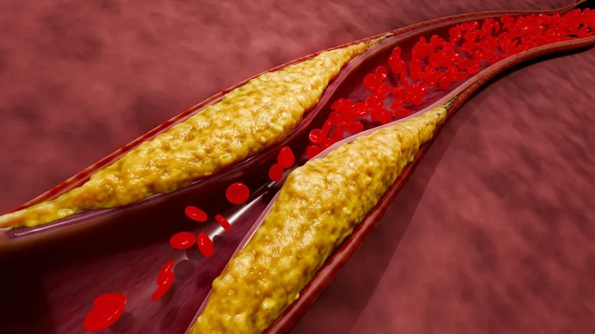 Waarom cardiologen zich zorgen maken bij pijnlijke kuiten tijdens het wandelen